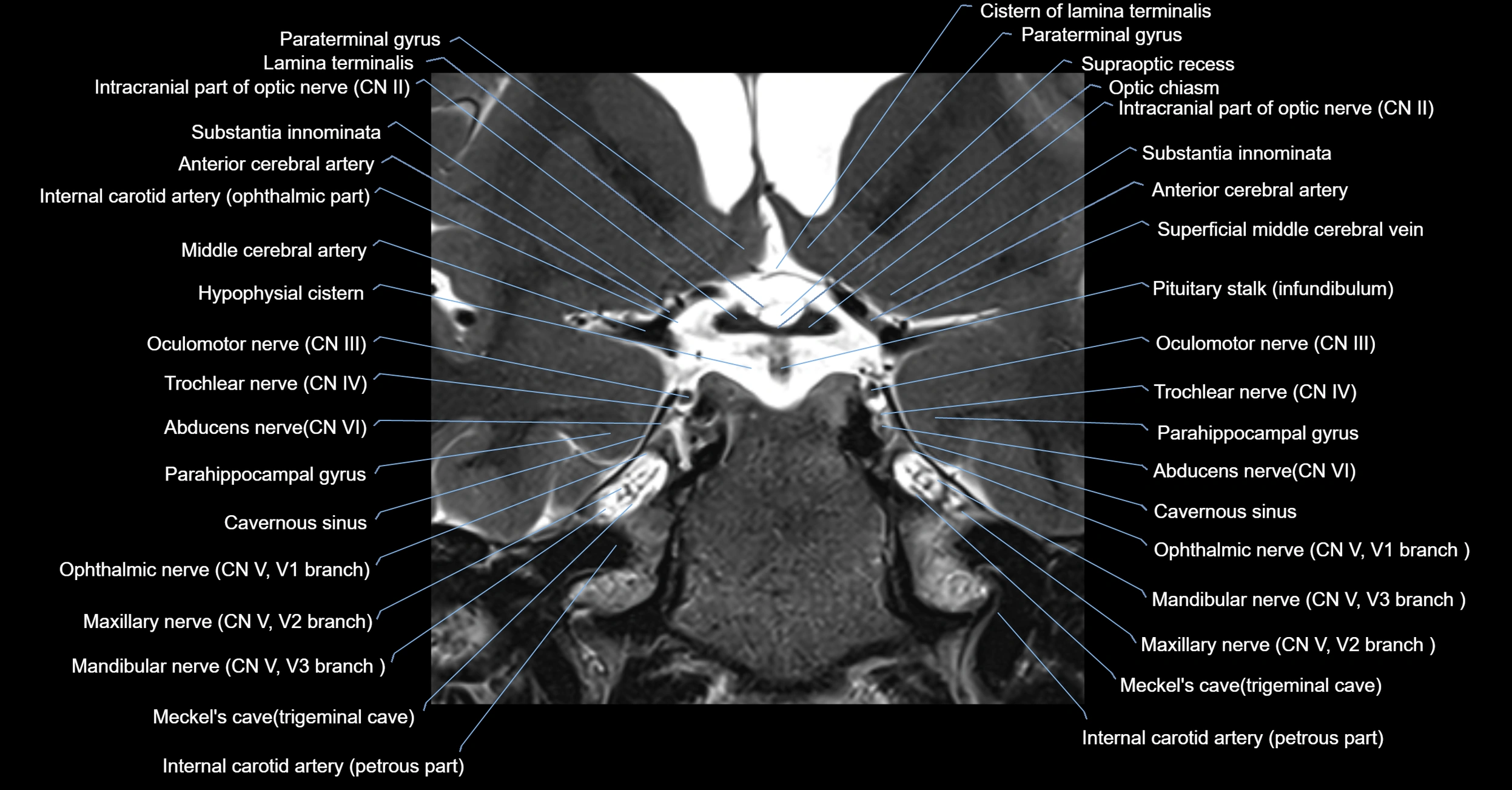 MRI cavernous sinus coronal cross sectional 3T anatomy image-img-00001-00013.webp